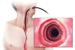 Esophagitis