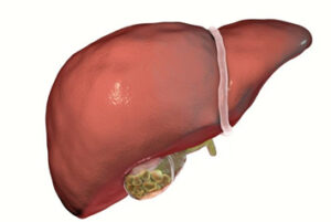 Gallbladder Disease