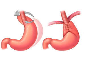 Hiatal Hernia Repair