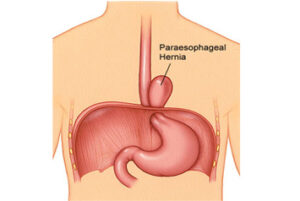 Paraesophageal Hernia